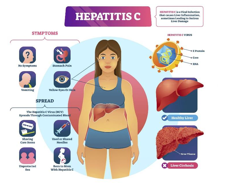 Hepatitis C Diagnosis