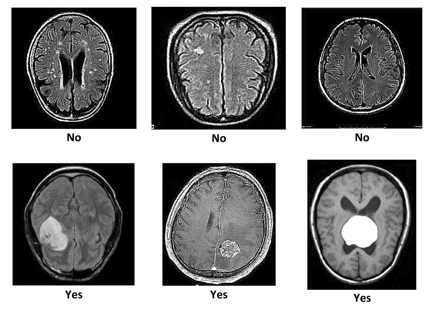 Brain Tuman Classification