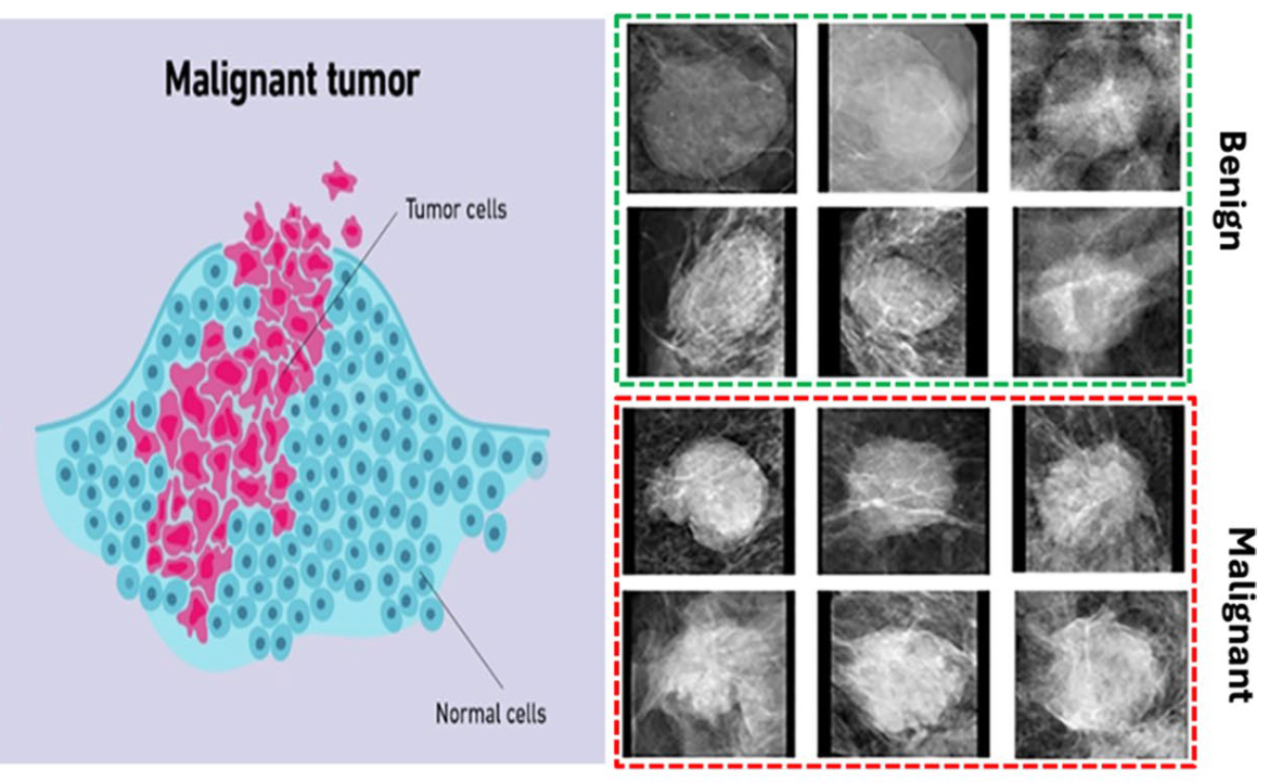 Breast Cancer Classification